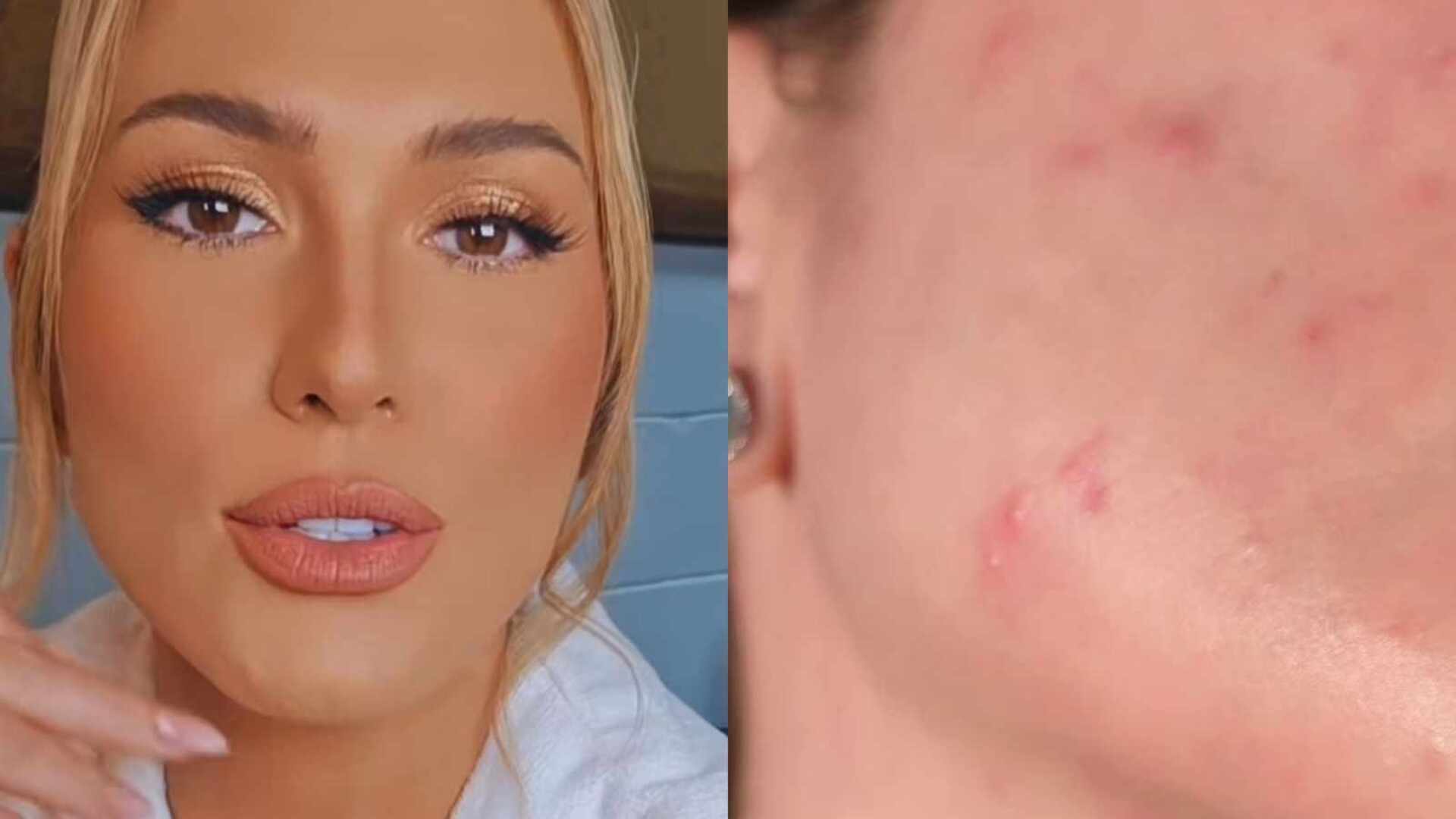 Lívia Andrade tira a maquiagem e impacta ao mostrar sua pele: ‘Crise’