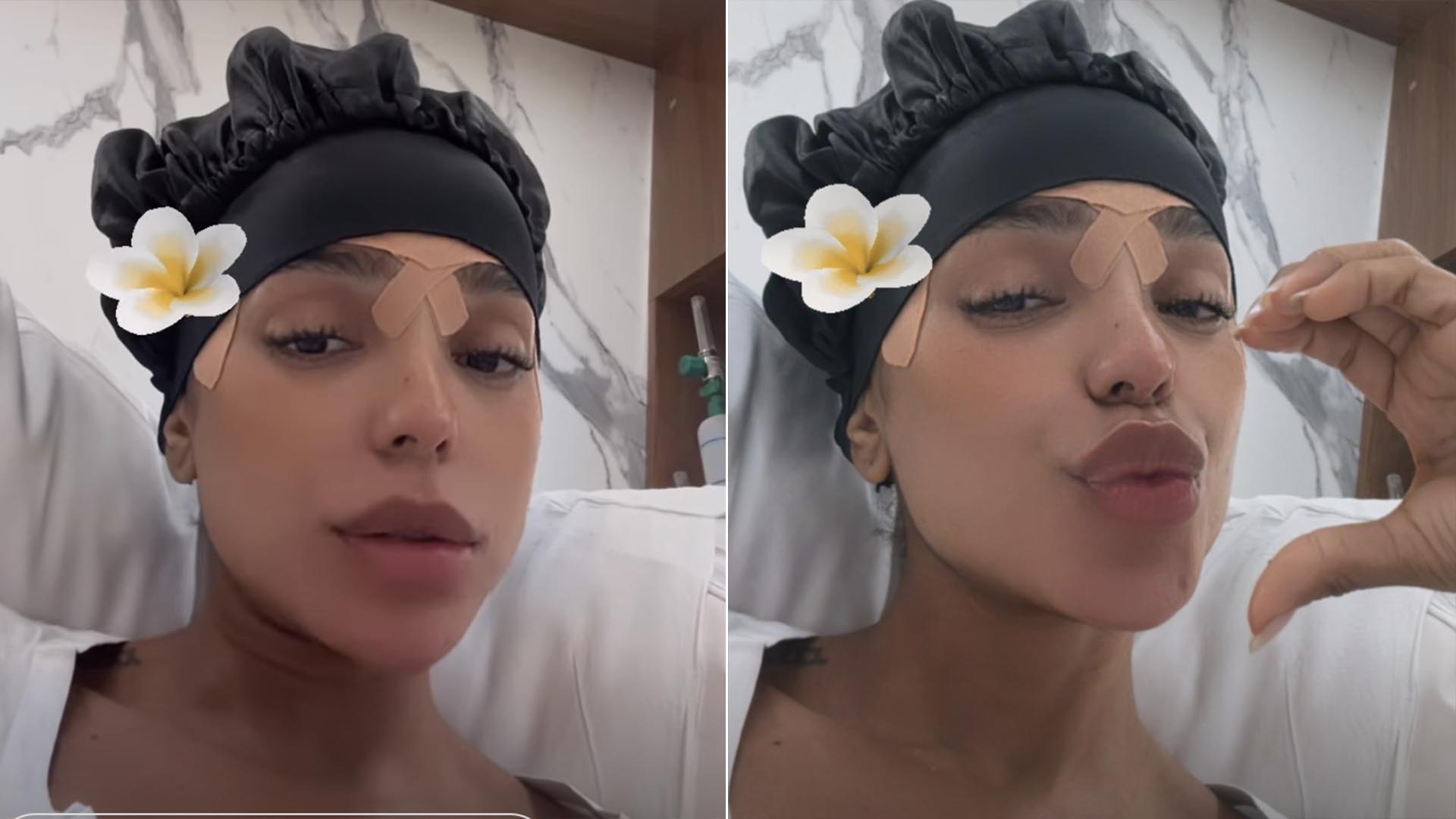 Veja o antes e depois da cirurgia de frontoplastia de Brunna Gonçalves