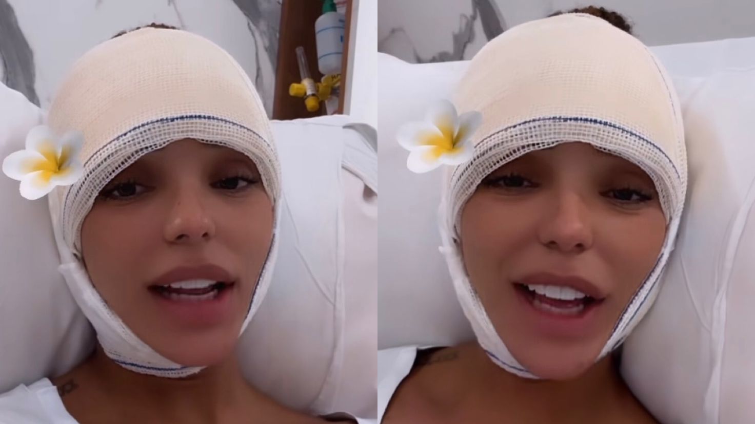 Brunna Gonçalves passa por frontoplastia, procedimento para reduzir a testa