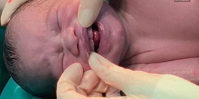 Bebê nasce com seis dentes no Mato Grosso do Sul e especialista alerta problemas; saiba quais