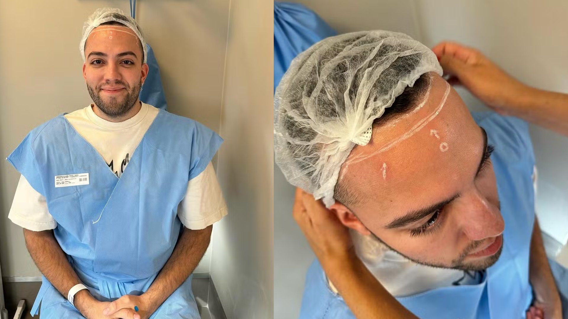 Lucas Rangel passa por cirurgia para diminuir testa: “Insegurança”