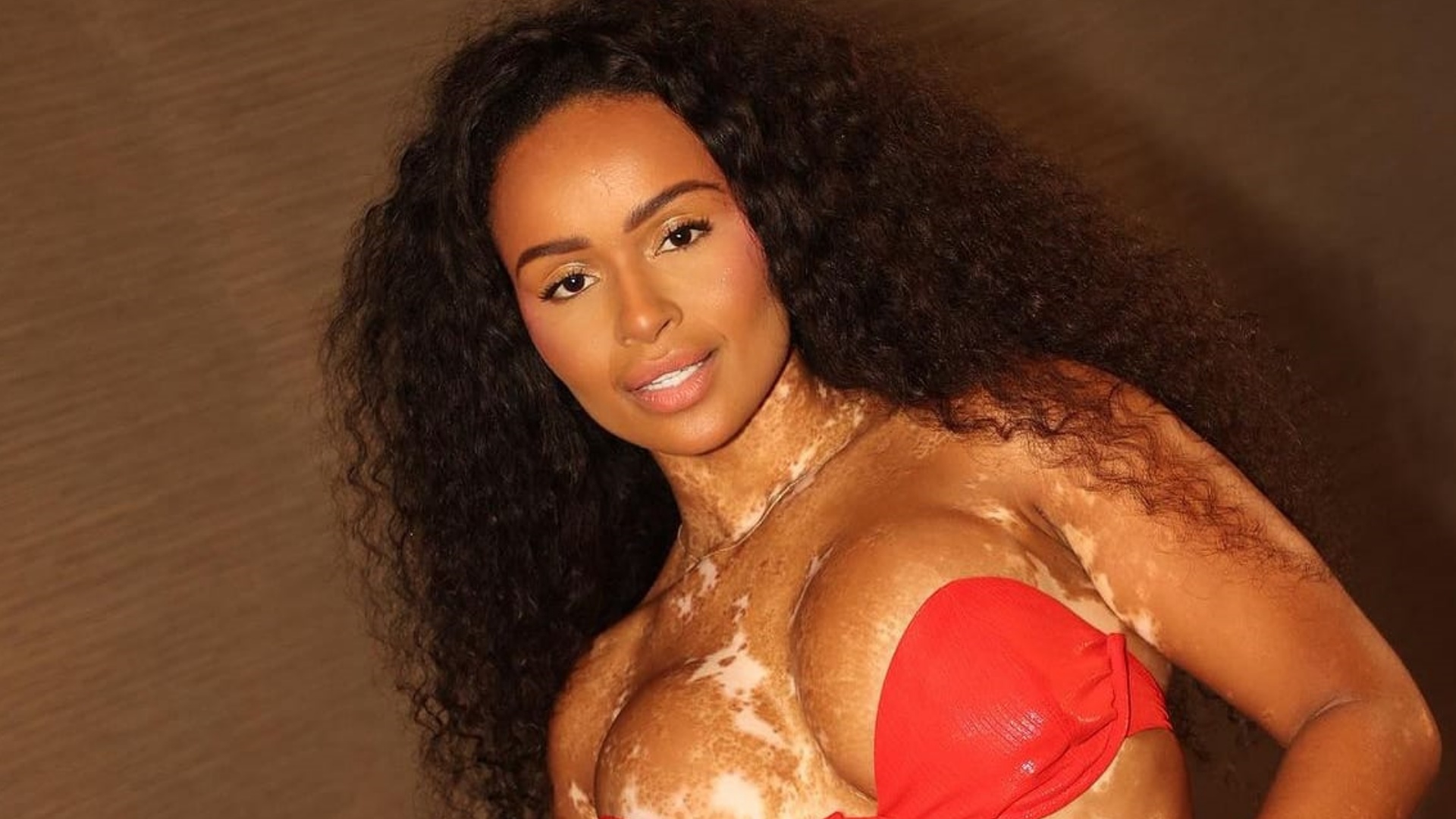 Natália Deodato reflete sobre representatividade no Dia Mundial do Vitiligo