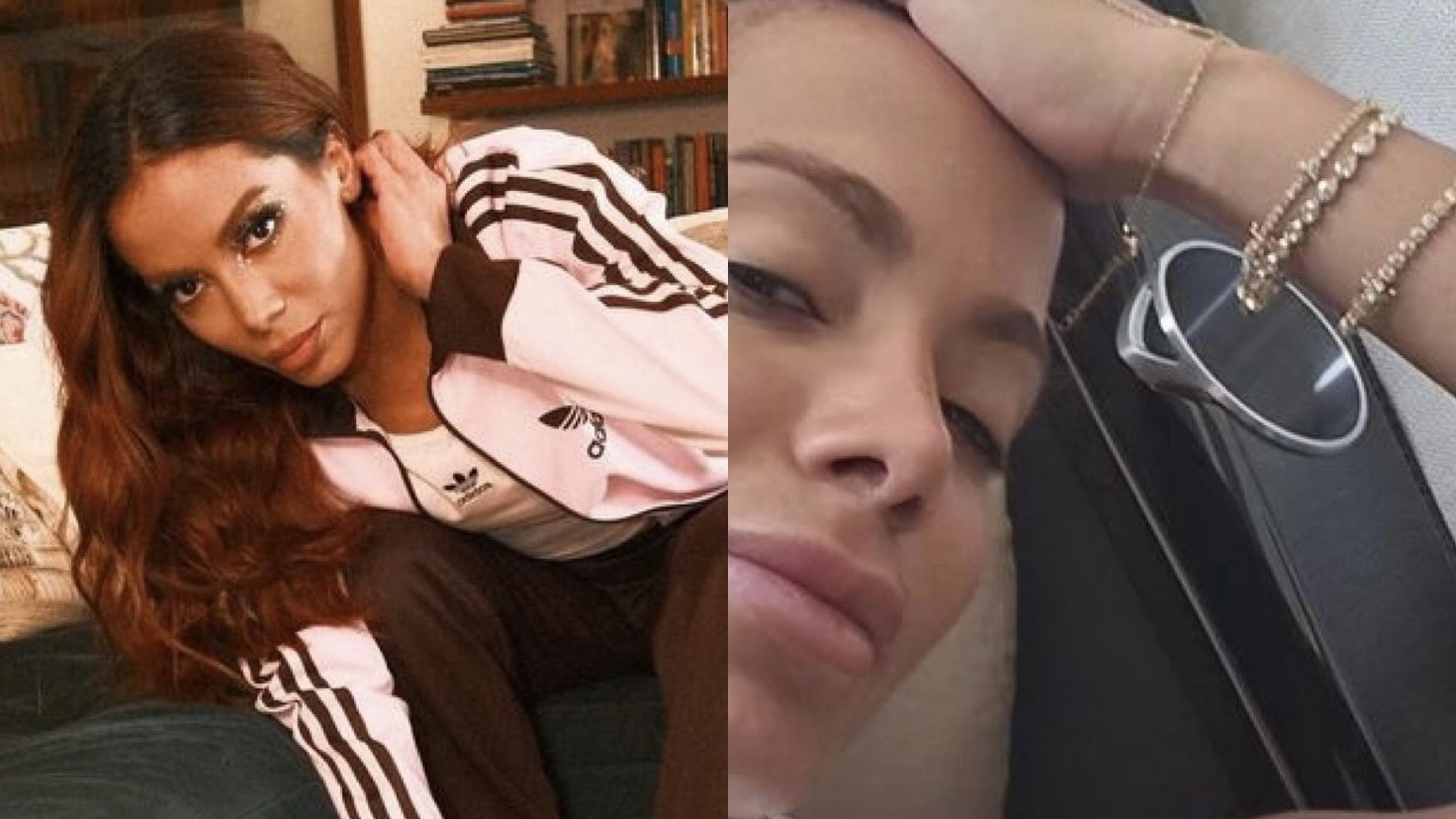 Anitta se preocupa com possível cicatriz após queimadura de água-viva