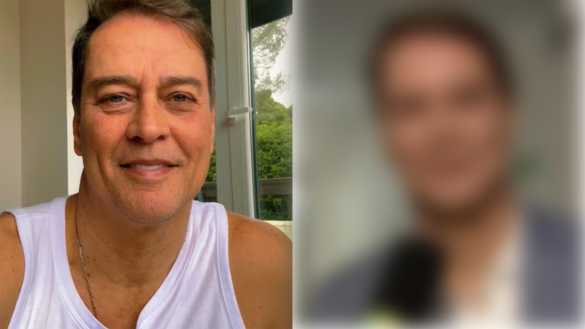 Marcello Antony faz harmonização facial. Veja o resultado da transformação