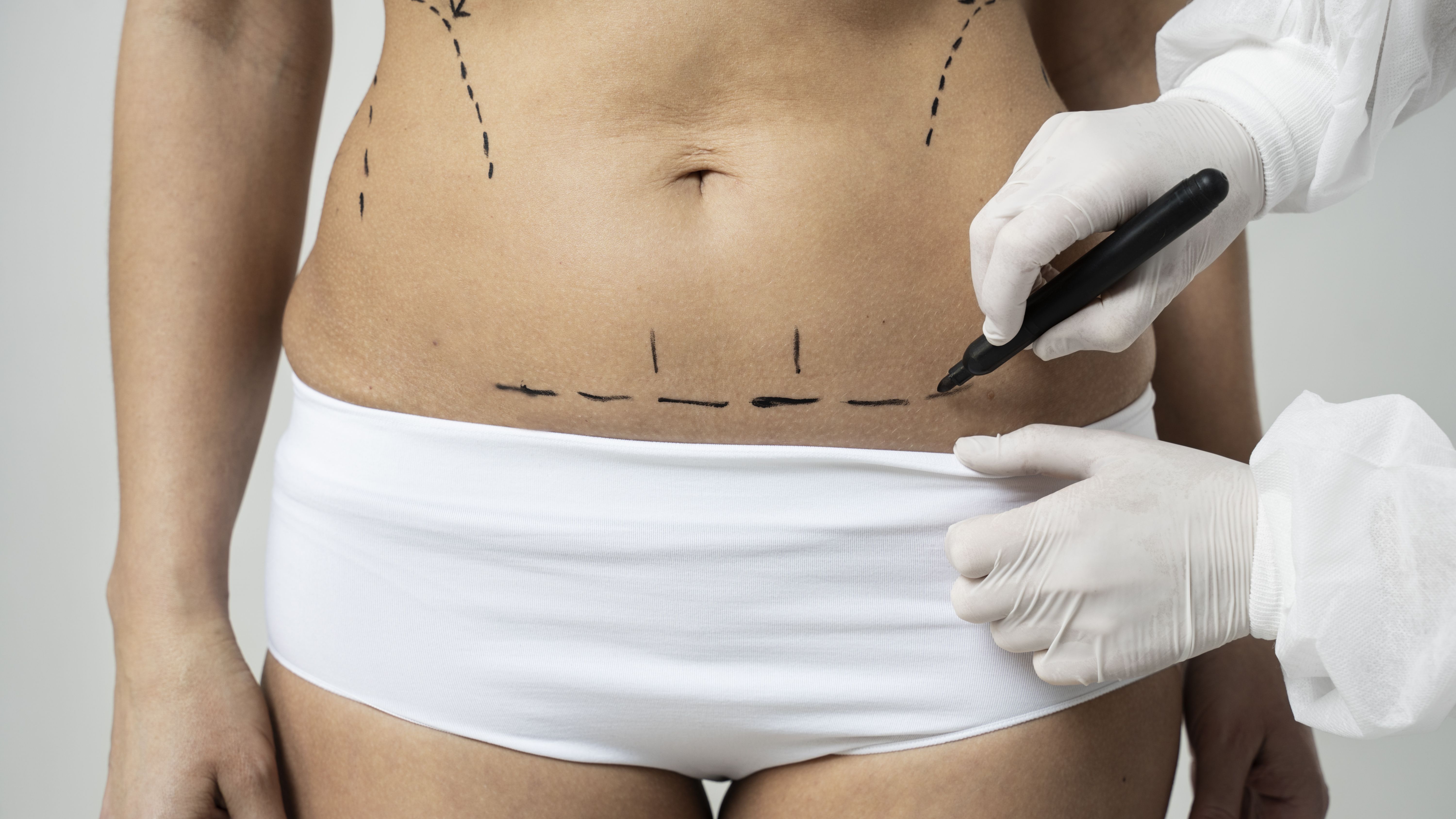 Saiba quando a retração de pele pode ser essencial após a lipoaspiração