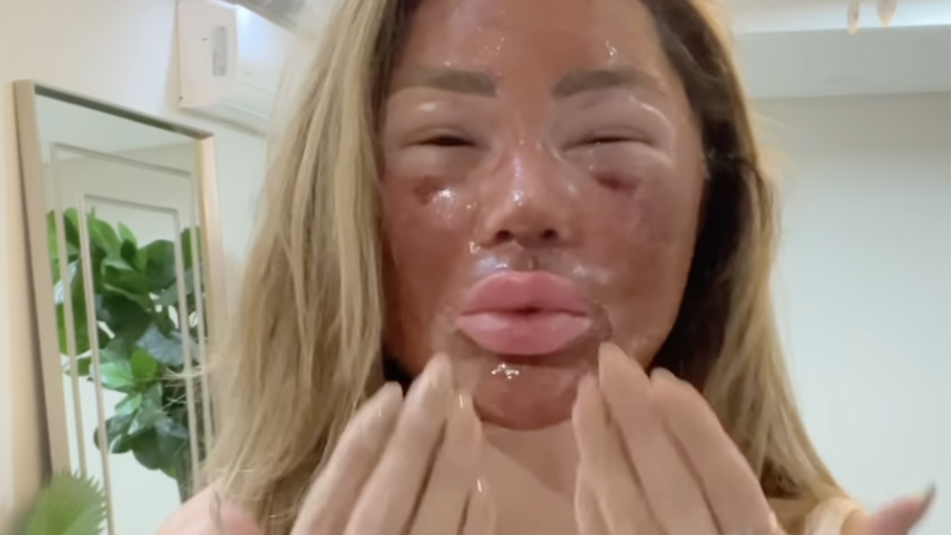 Influenciadora faz o peeling de fenol e impressiona com antes e depois