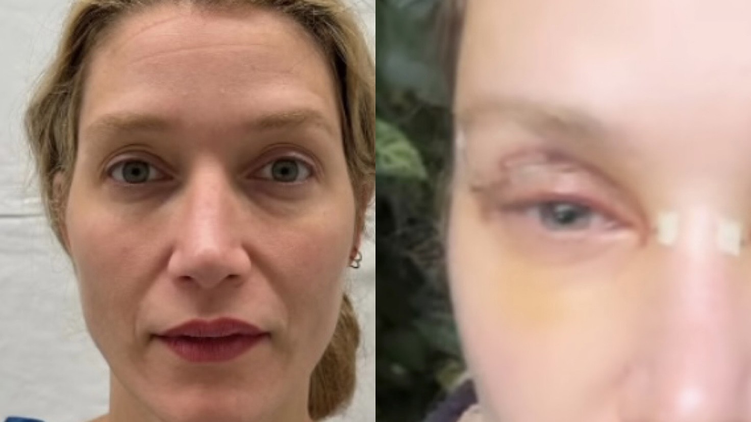 Gabriela Pugliesi conta detalhes de pós operatório e mostra antes e depois