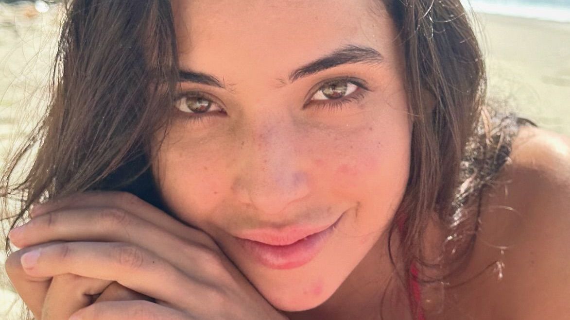 O que pode causar a acne? Entenda doença que atinge a pele de Vanessa Lopes