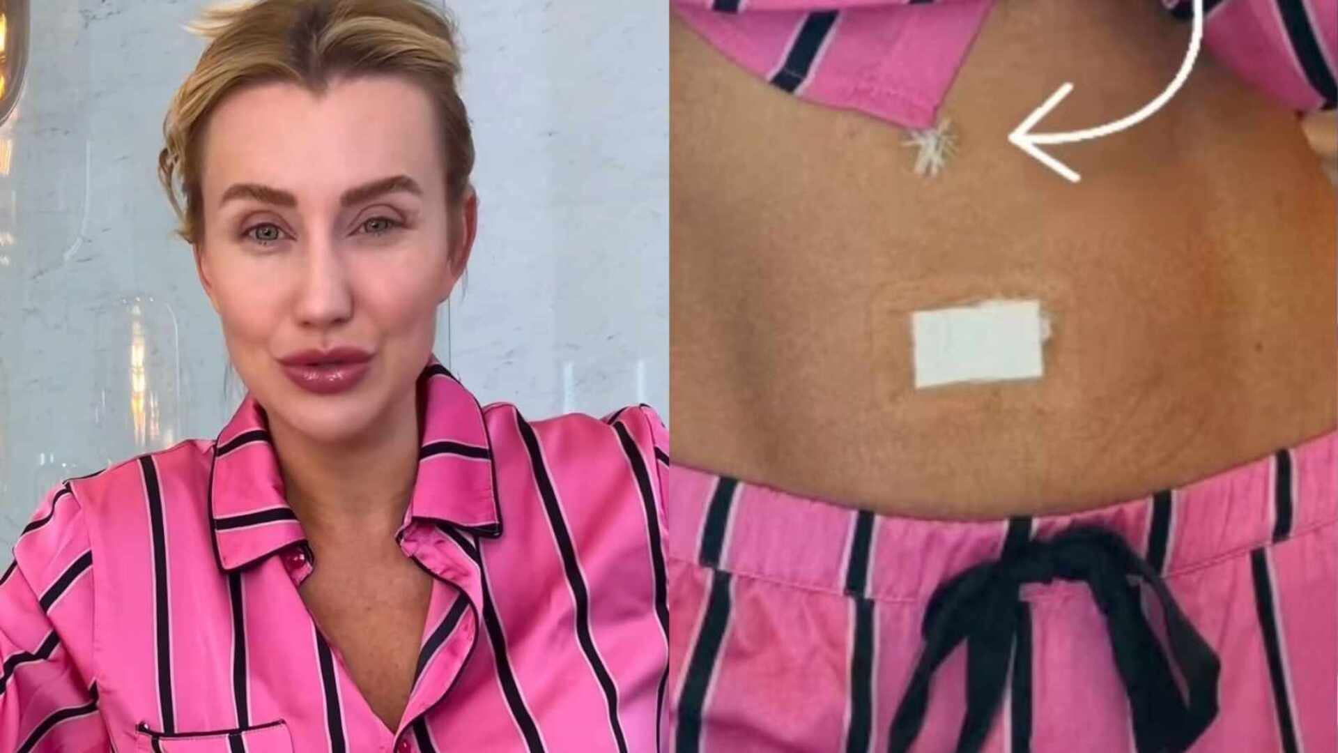 Ana Paula Siebert mostra inchaço e cicatriz após cirurgia: ‘Piorou’