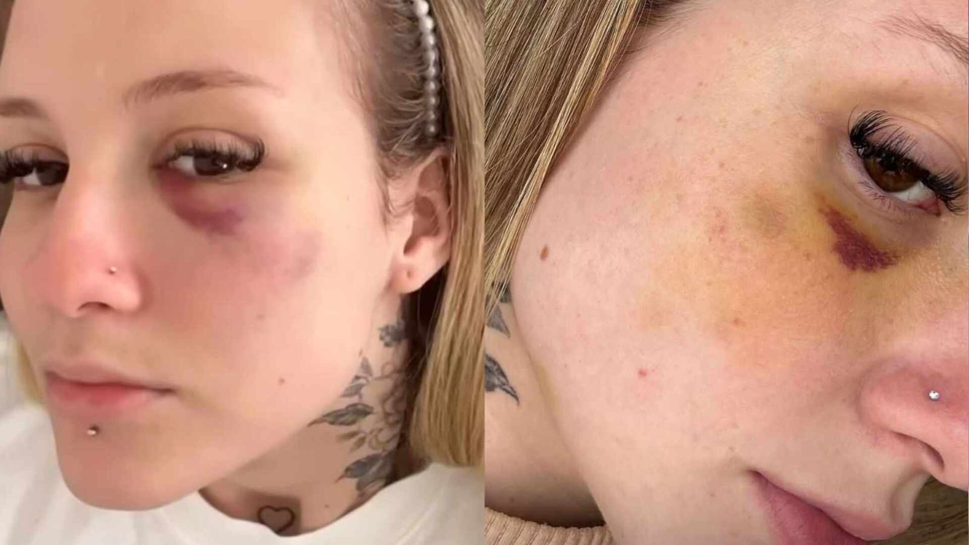 Ex-mulher de jogador, Clara Monteiro exibe hematomas de agressão
