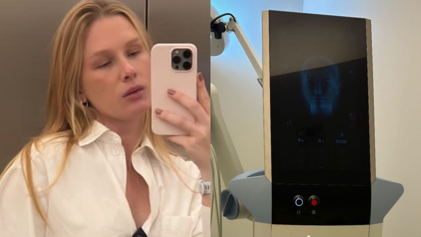 Fiorella Mattheis faz procedimento estético após chegada do segundo filho: ‘Lifting’