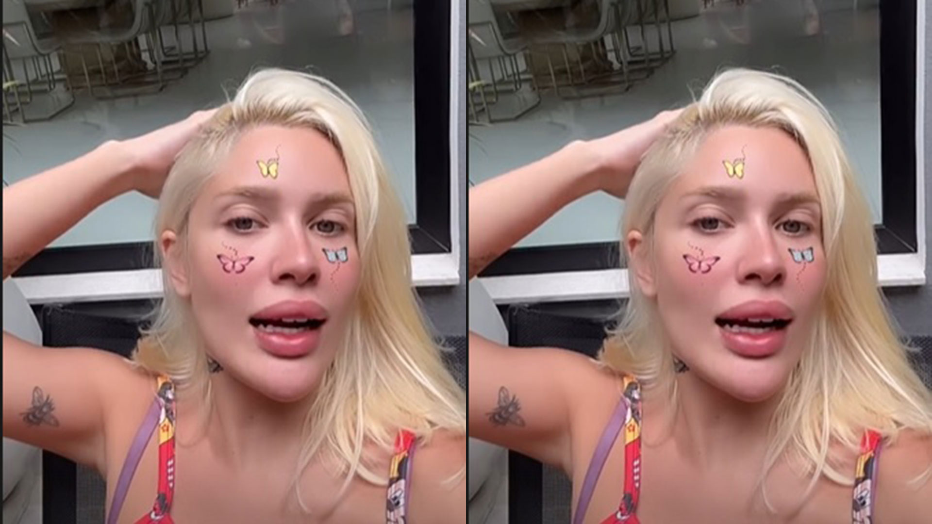 Karoline Lima dá detalhes de queimadura com babyliss: ‘Muito feio’