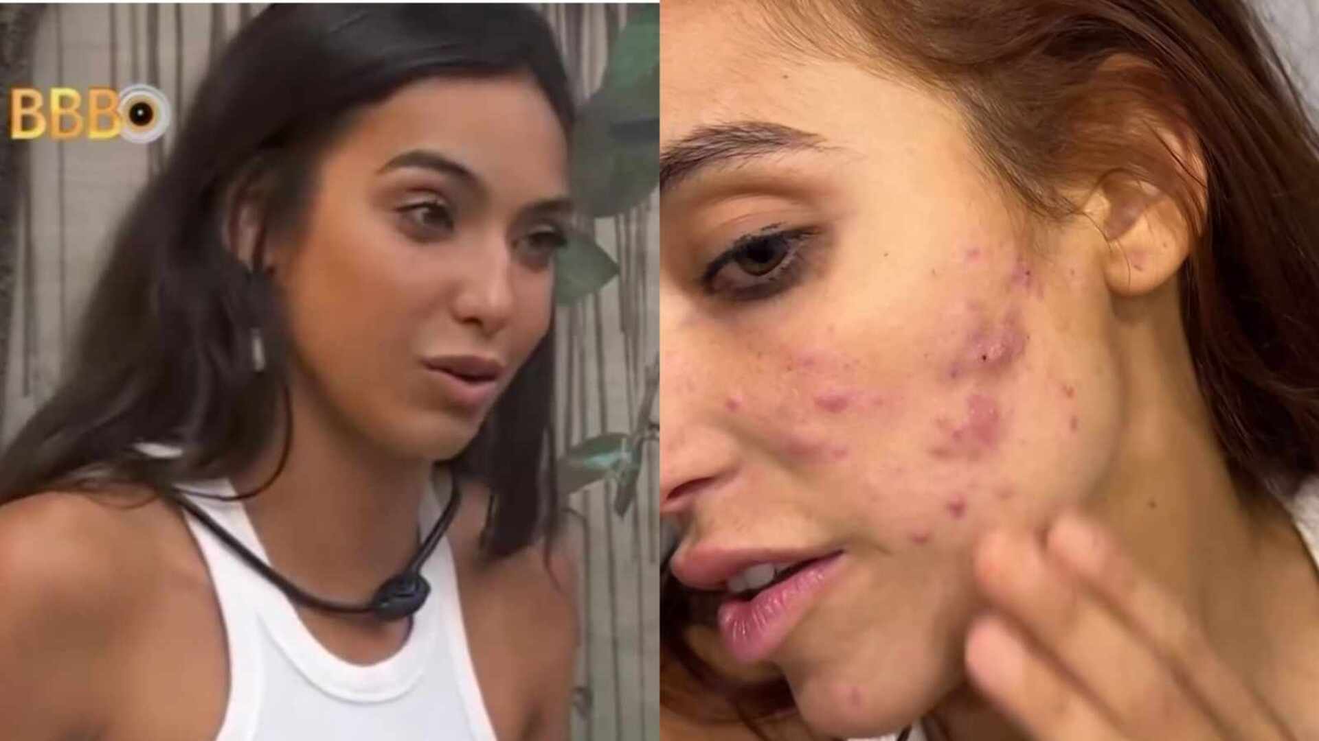 Ex-BBB Vanessa Lopes desabafa ao mostrar situação de seu rosto com acne