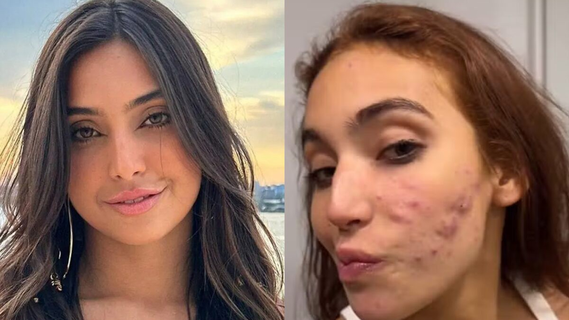 Vanessa Lopes tem reação após crise com acne; entenda o caso