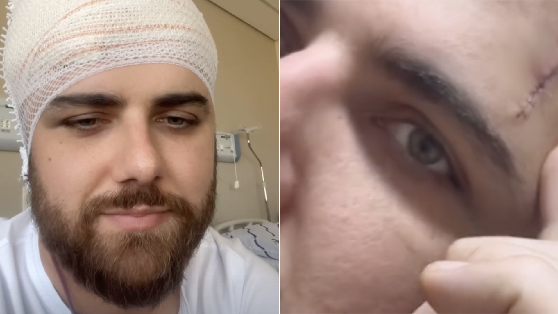 Zé Neto choca ao mostrar o tamanho do corte em sua cabeça: ‘Bem grande’