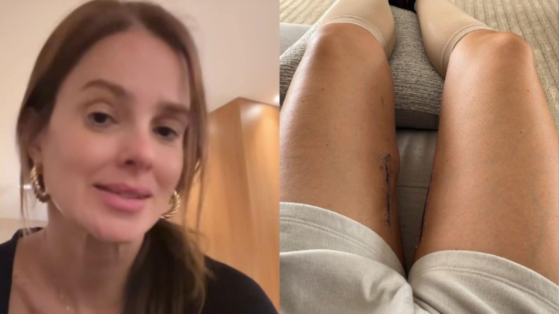 Vera Viel mostra como estão as cicatrizes de suas pernas: ‘Tenho duas’