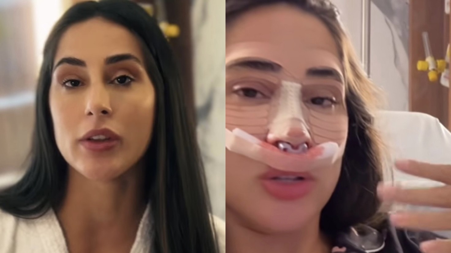 Após rinoplastia, ex-BBB Deniziane descreve recuperação de cirurgia