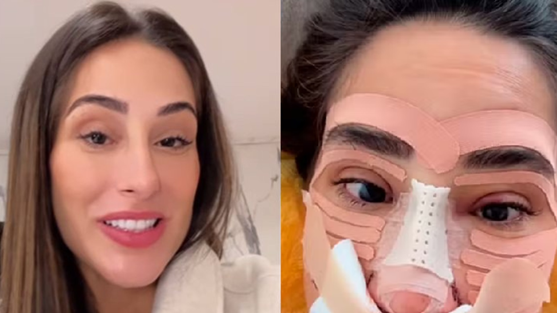 Como está Deniziane Ferreira? Ex-BBB mostra inchaço após cirurgia