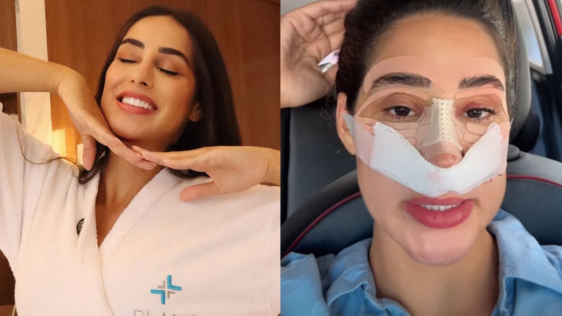 Quanto custou a rinoplastia de Deniziane? Ex-BBB revela valor de cirurgia plástica