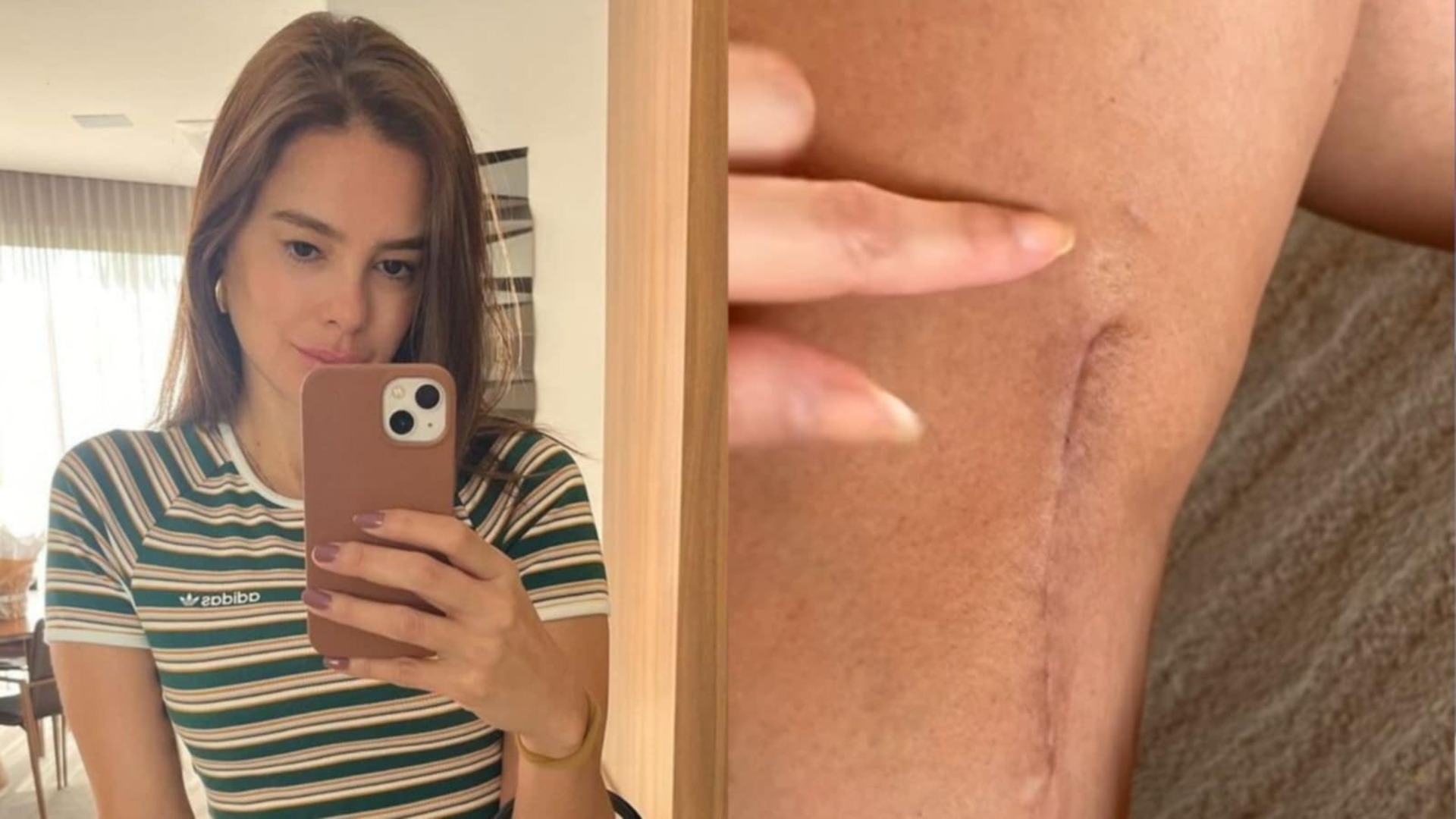 Vera Viel mostra como estão sua cicatriz e pele após iniciar radioterapia