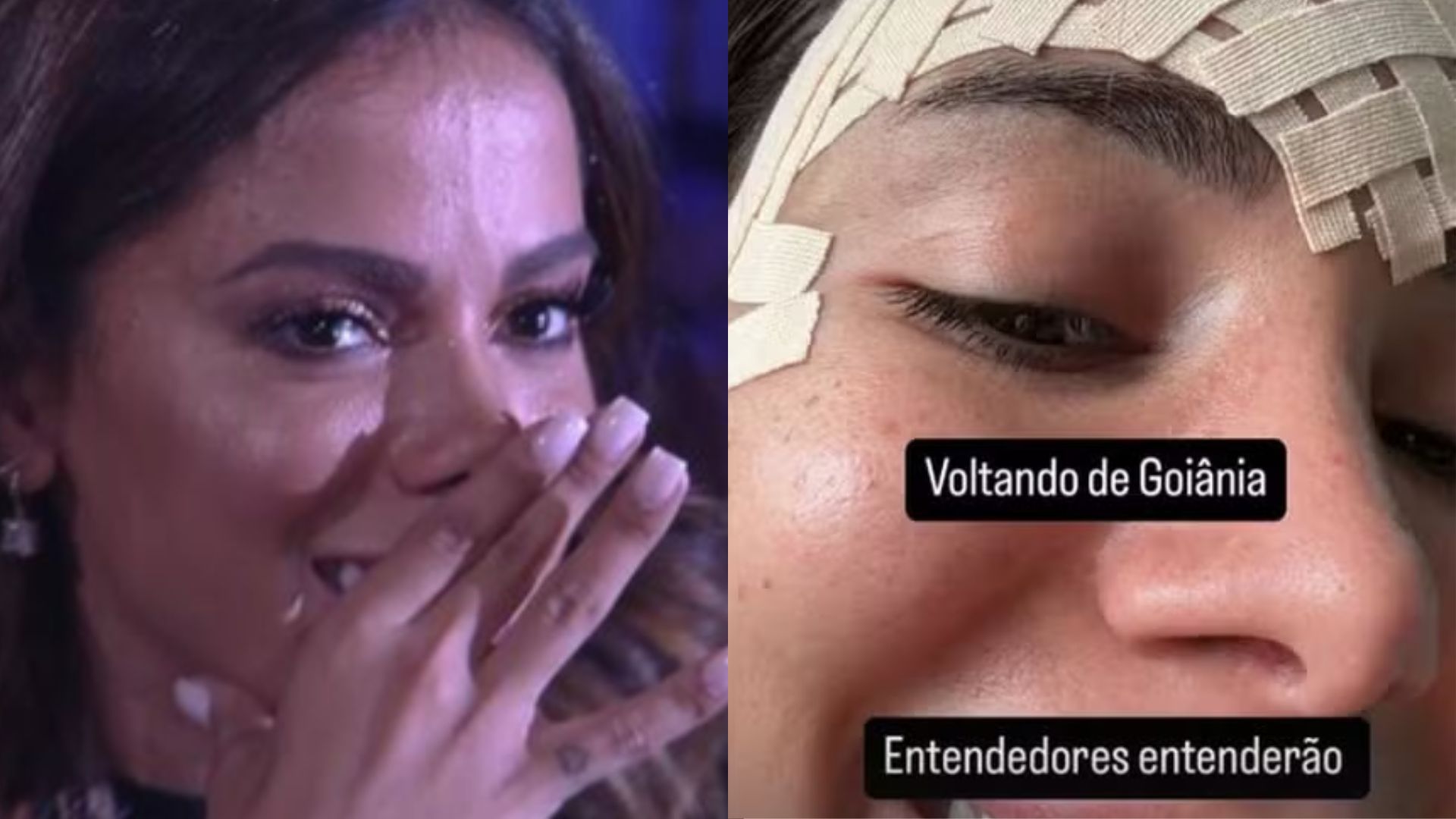 Anitta retira veia da testa: médico explica procedimento e riscos