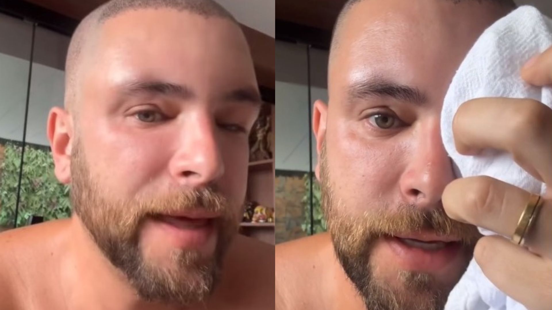 Ex-BBB Gustavo Marsengo exibe situação do rosto após procedimento: ‘Não se assustem’