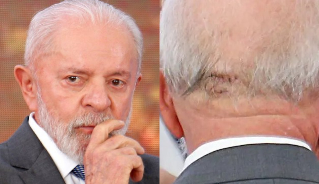 Cicatriz de Lula: É possível recuperar fios perdidos em áreas cicatrizadas com transplante capilar?