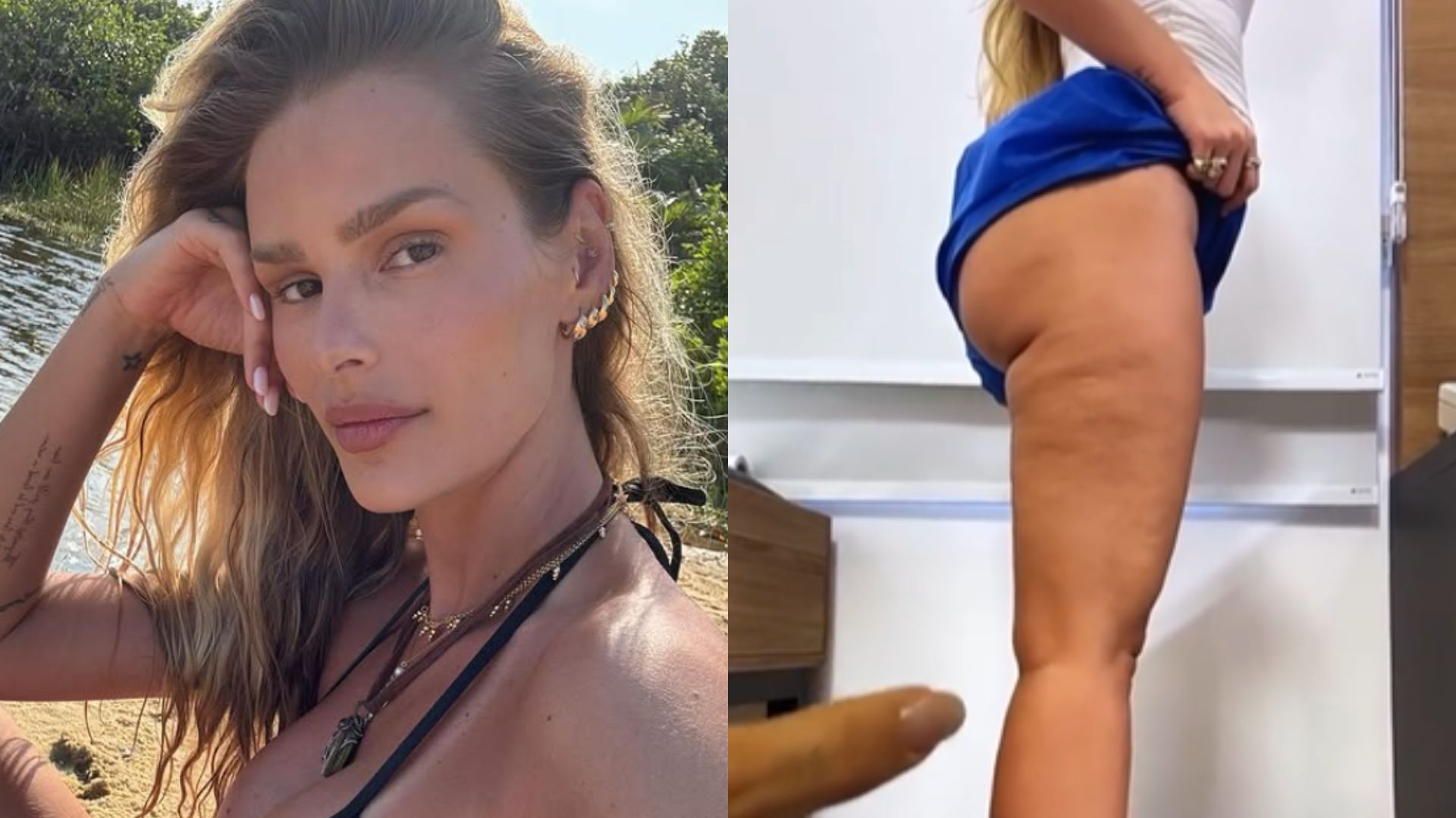 Yasmin Brunet celebra antes e depois de tratamento para lipedema