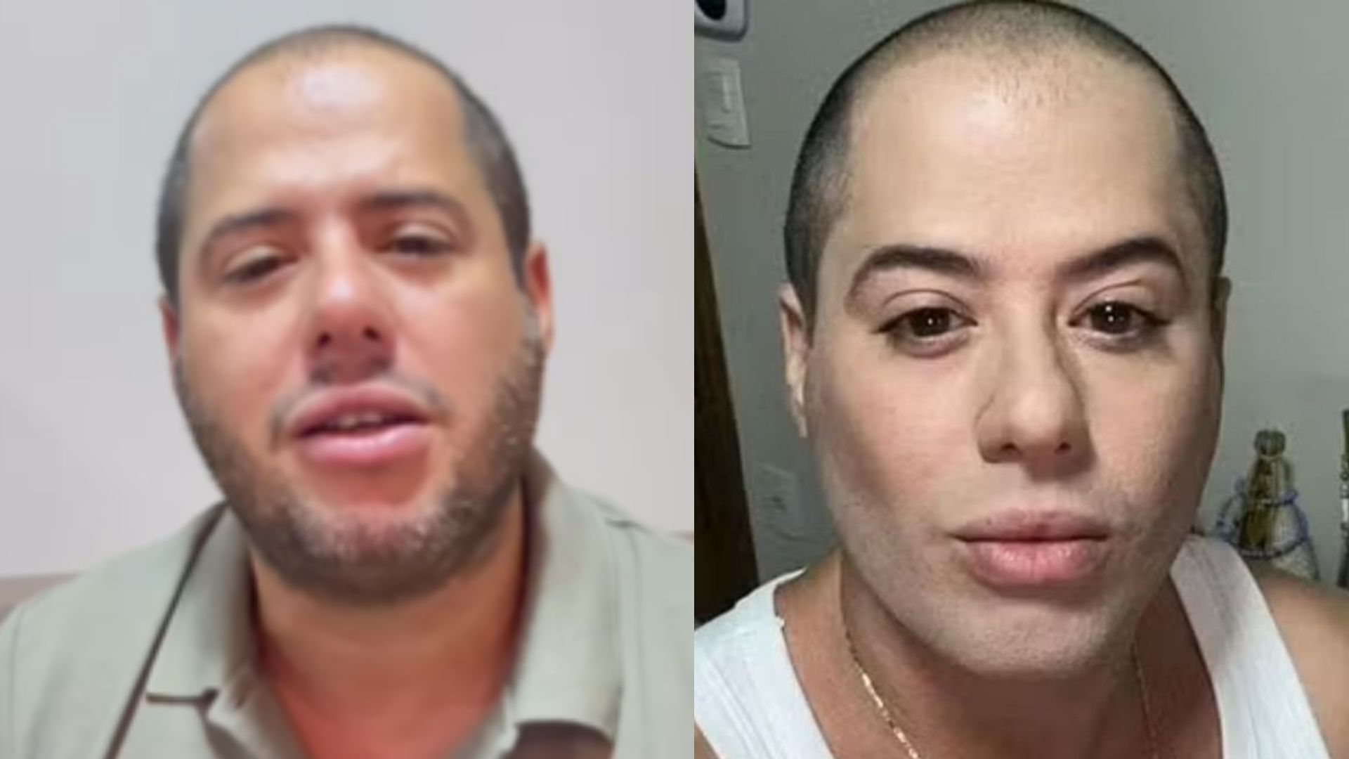 Após foto polêmica, Hugo explica novo visual e nega procedimento estético