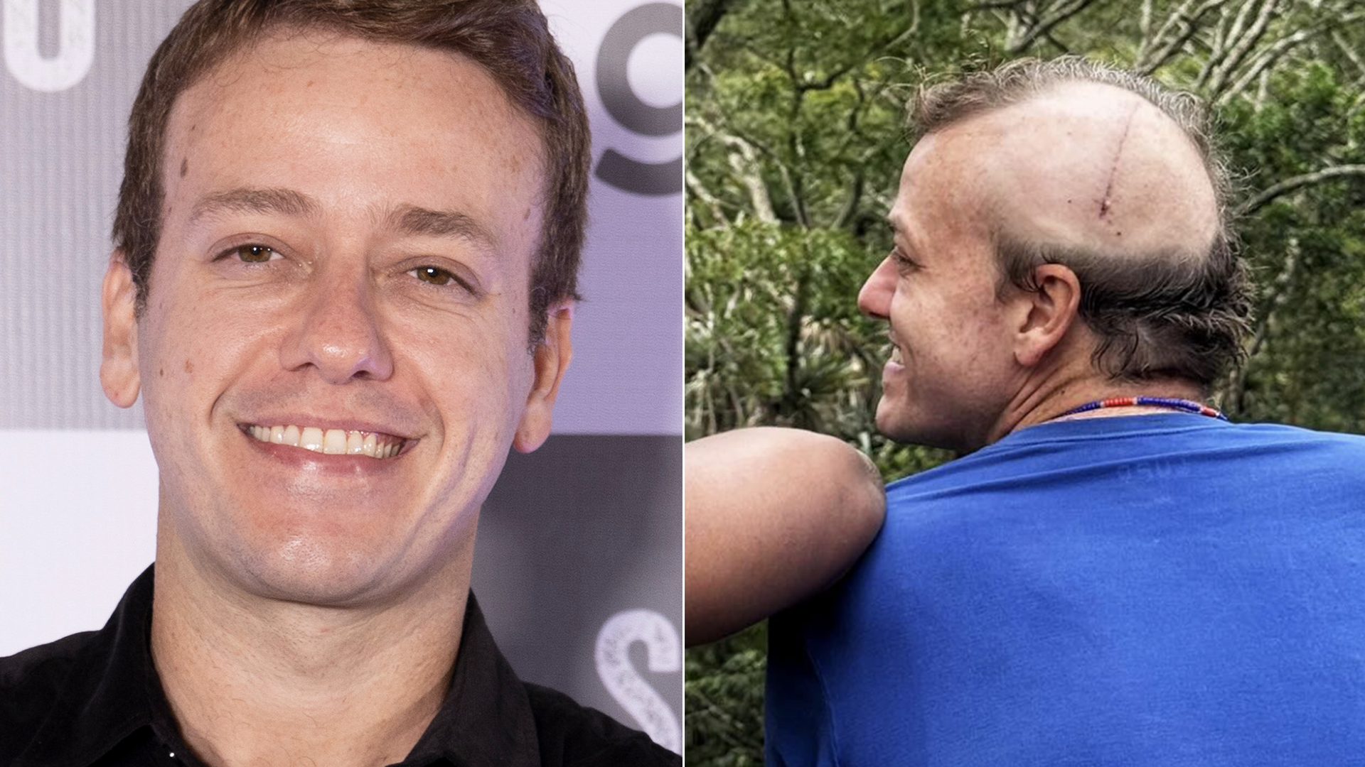 Pablo Sanábio retira tumor no cérebro e faz tratamento: ‘Convulsões’