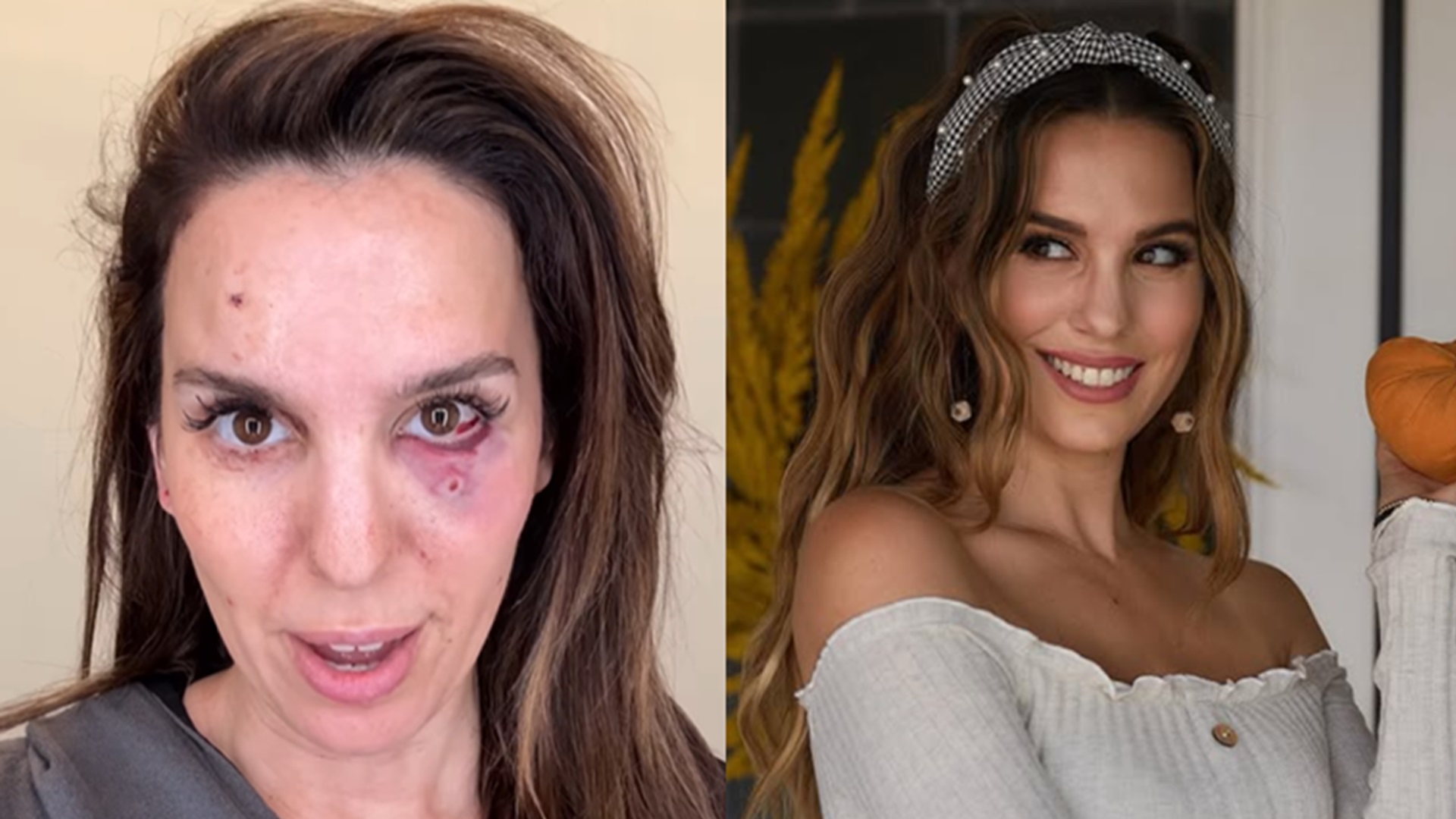 Ex-atriz da Disney quase perde a visão após ser baleada: ‘Vi a vida passar diante dos olhos’