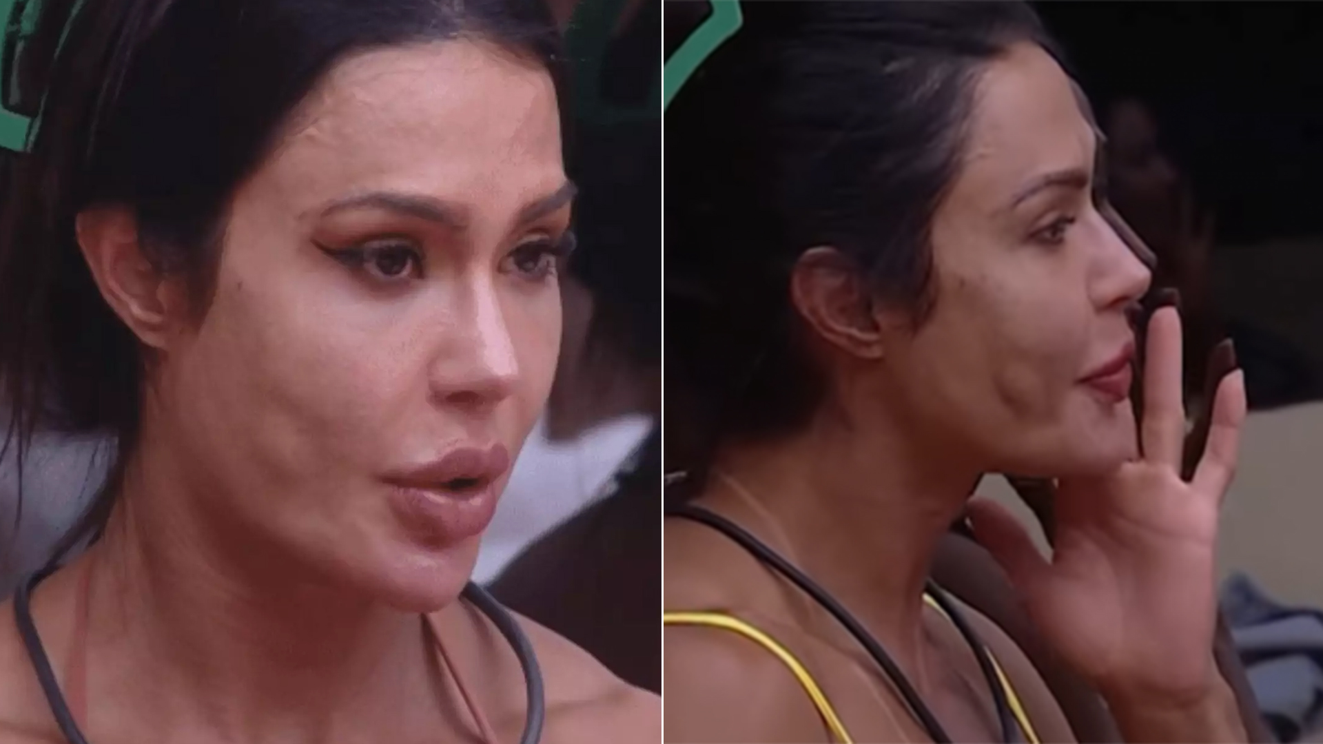 O que é a bolinha no rosto de Gracyanne? Especialista explica os detalhes