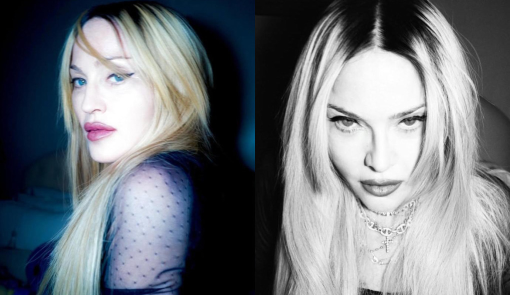 Madonna surge mais jovial e especialista explica tendência: ‘Resultados mais sutis’