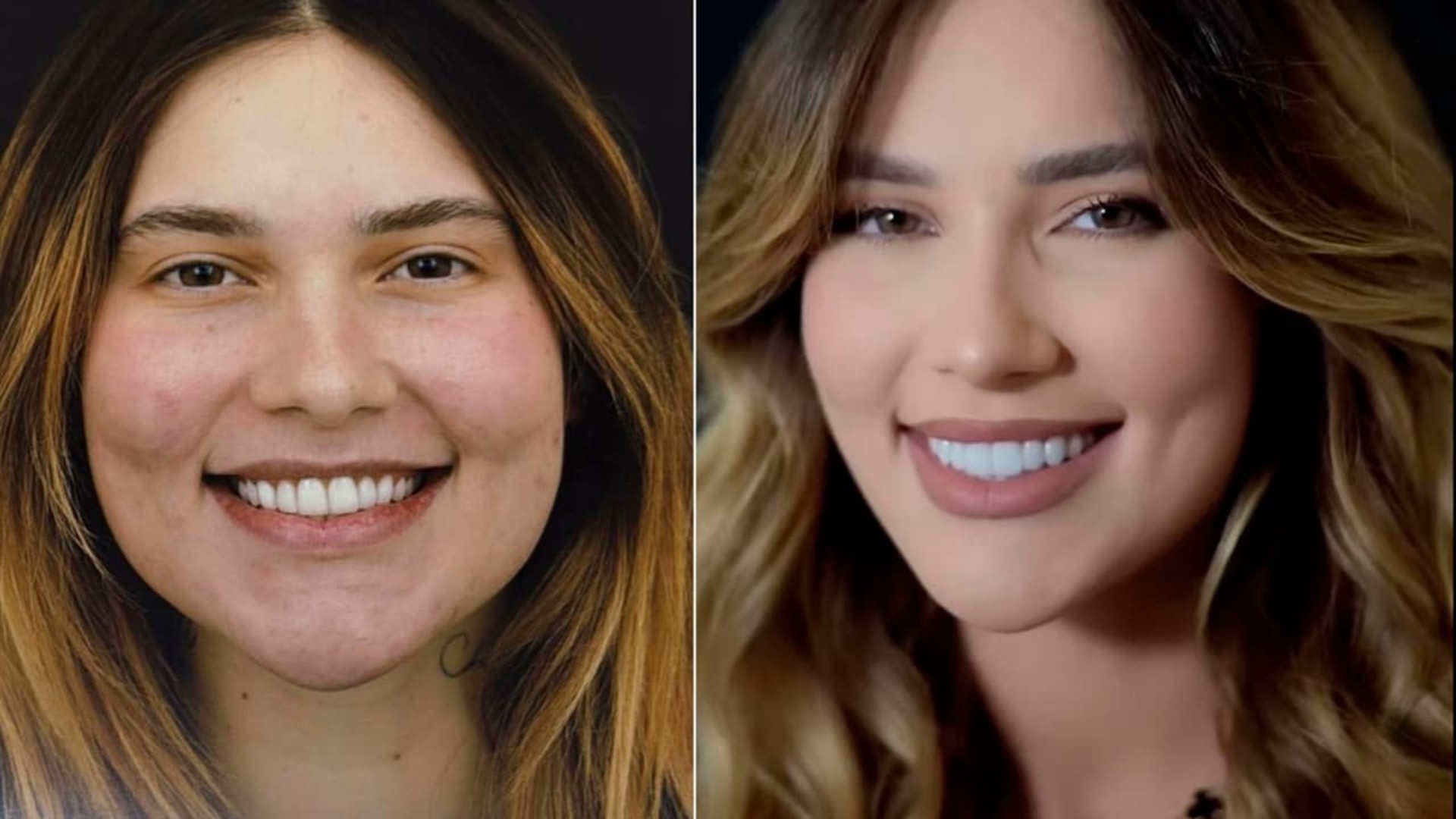 Dentista explica principal mudança no sorriso de Virginia Fonseca: ‘Corrigiu’