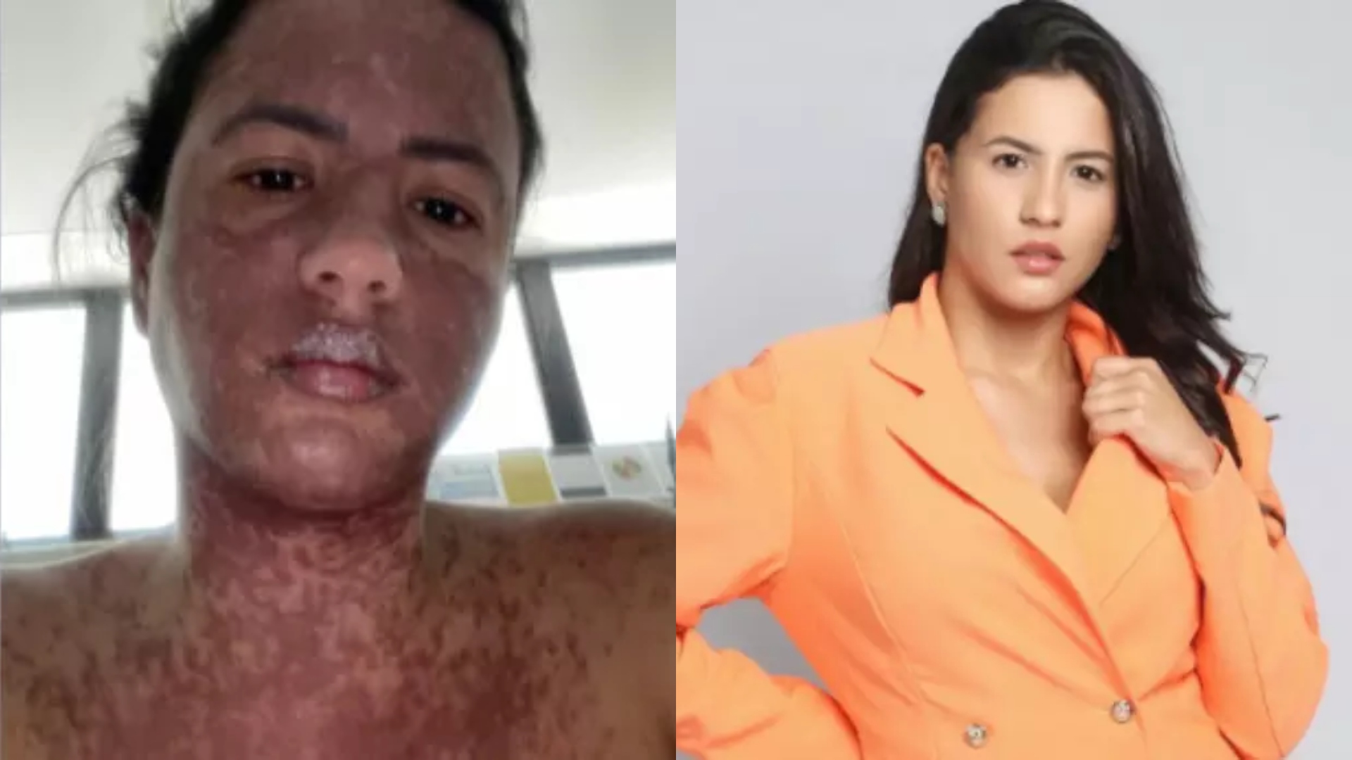 Alerta médico sobre doença que deixou o rosto da ex de Frank Aguiar deformado: ‘Uma ameaça’