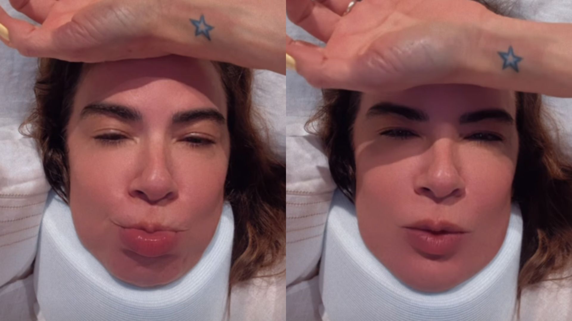 Luciana Gimenez revela hematomas pós-operatório: ‘Toda roxa’