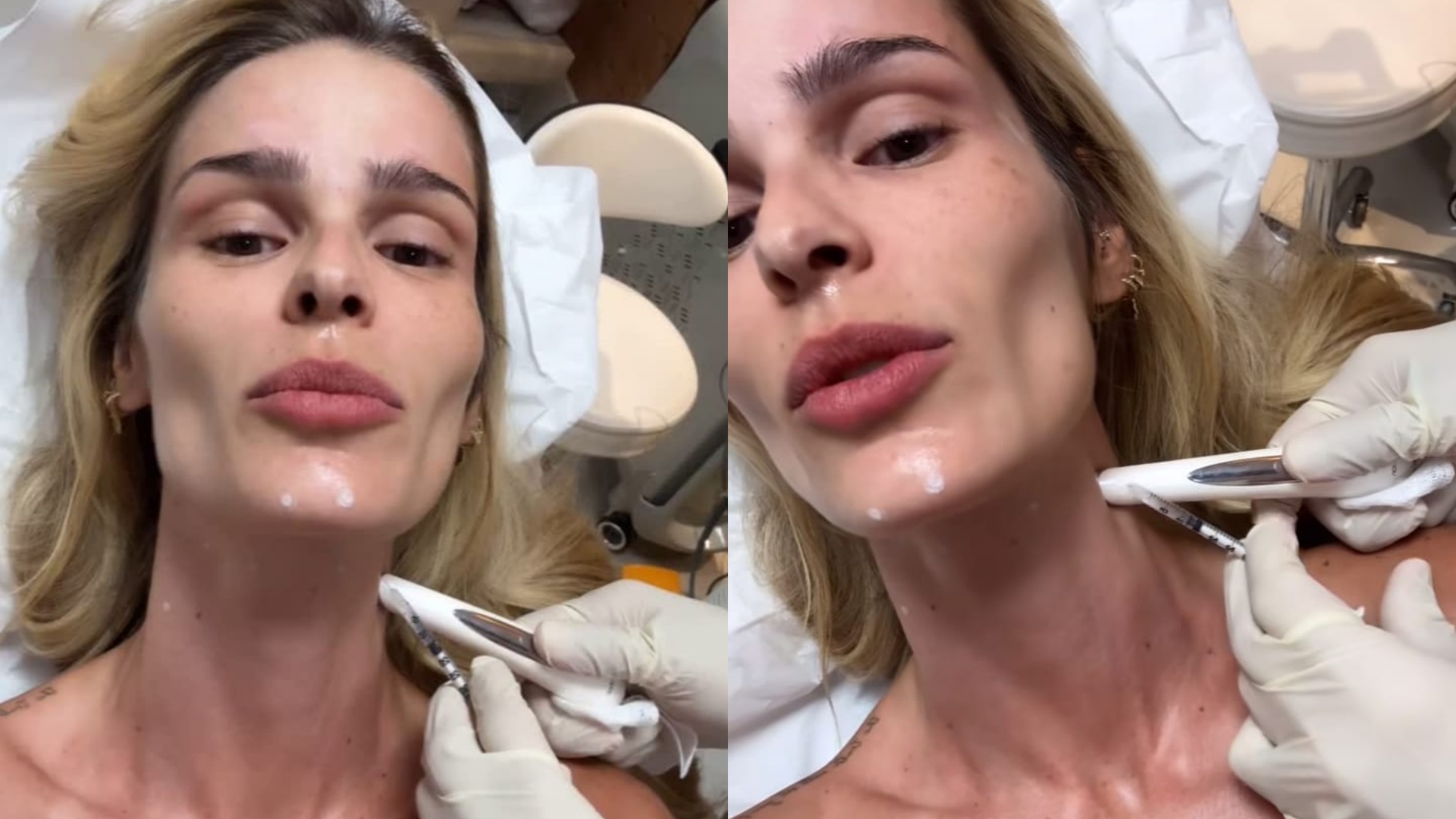 Botox nefertiti: entenda o procedimento realizado em Yasmin Brunet