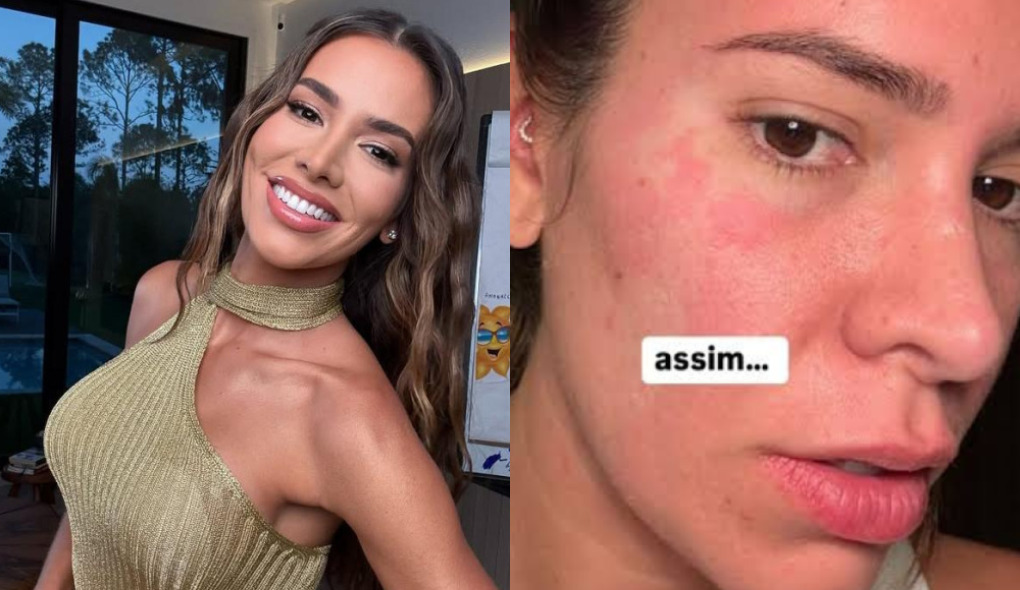 Médica faz alerta sobre condição da ex-BBB Adriana Sant’Anna: ‘Diagnóstico não é simples’