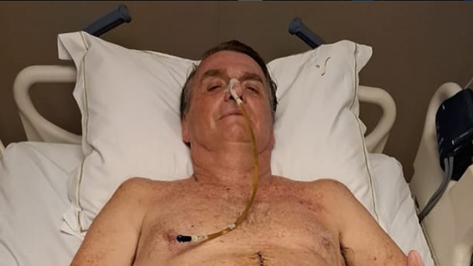 Jair Bolsonaro mostra como está sua cicatriz e atualiza estado de saúde após cirurgia