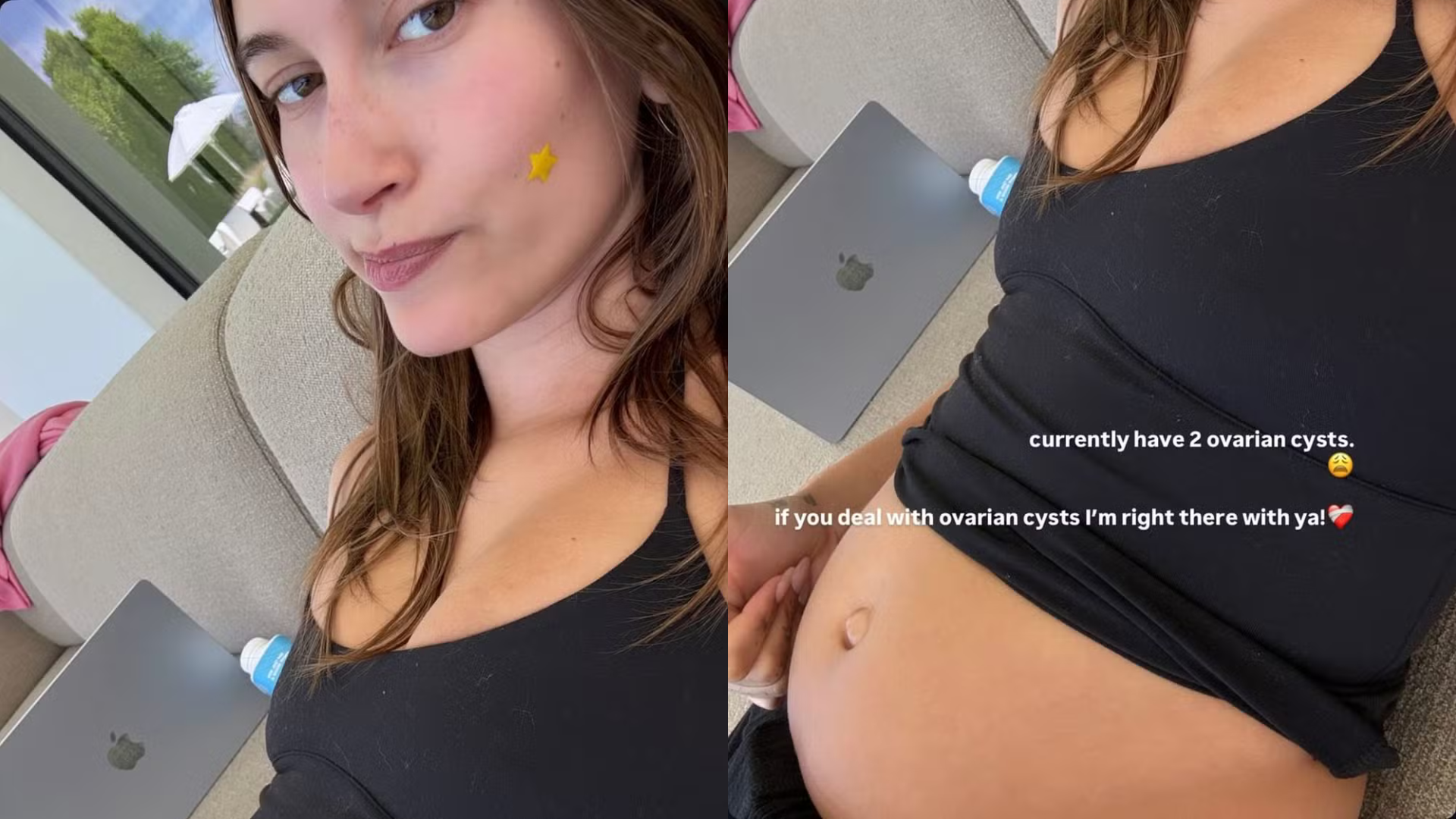 Médico explica diagnóstico de Hailey Bieber com barriga inchada: ‘Bem raros’
