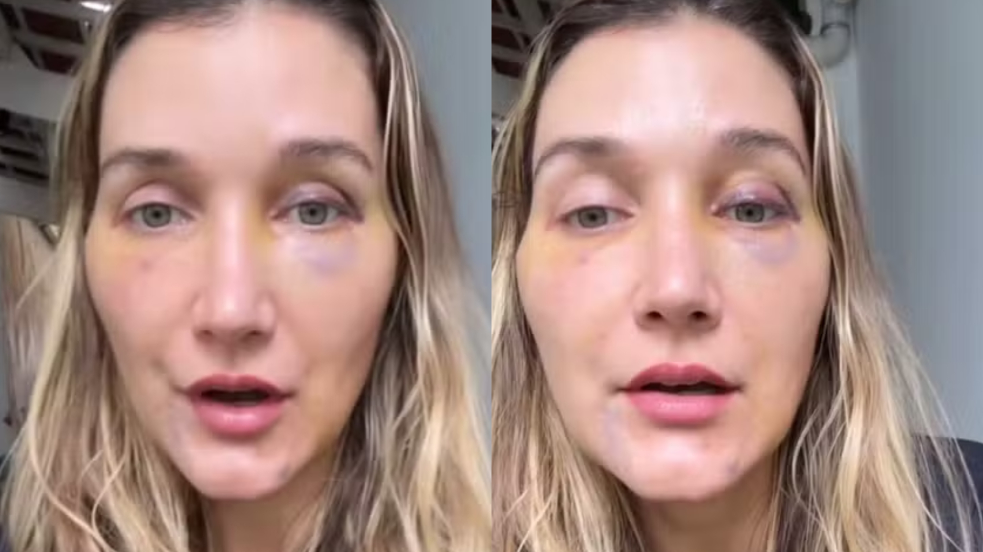 Médica explica procedimento com células-tronco feito por Gabriela Morais: ‘Rejuvenescimento’