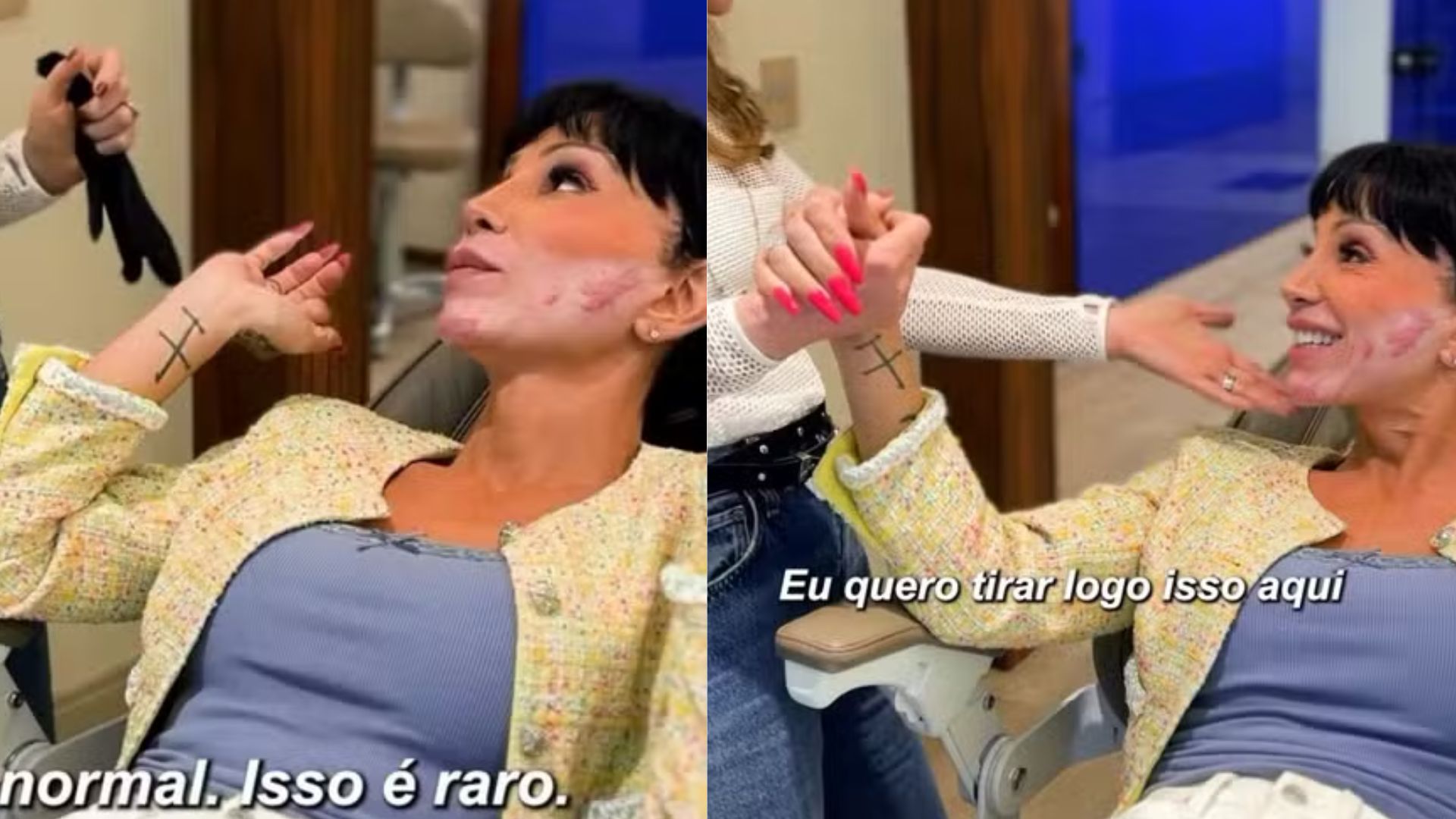 Maya Massafera mostra reação no rosto após uso excessivo de hormônios
