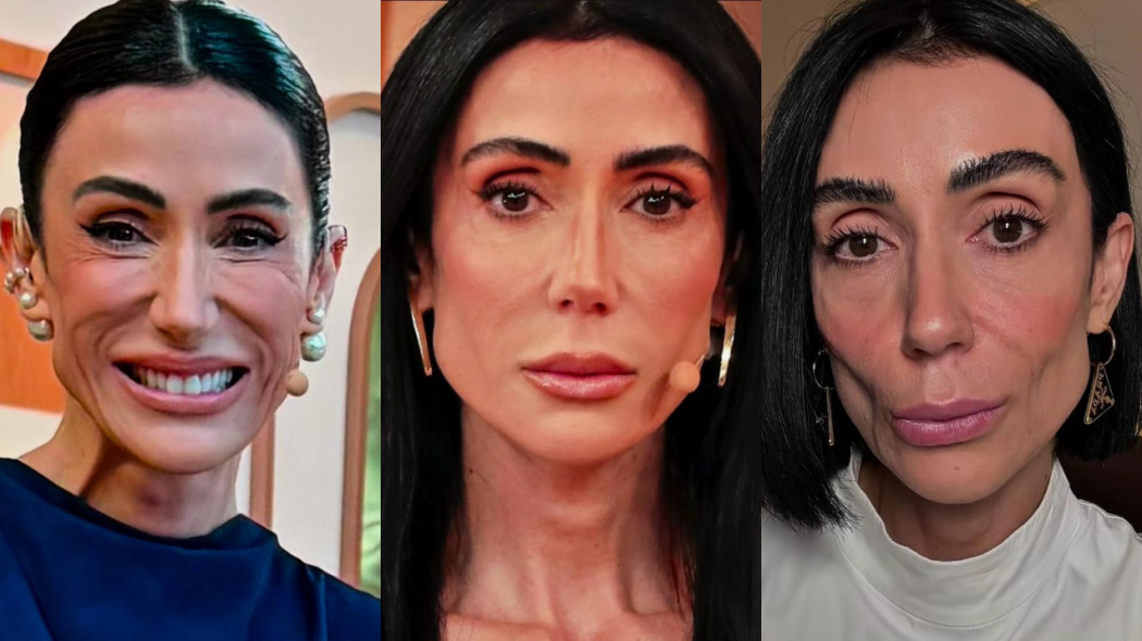 Especialista explica fenômeno que causou flacidez à Michelle Barros: ‘Insatisfação não é incomum’