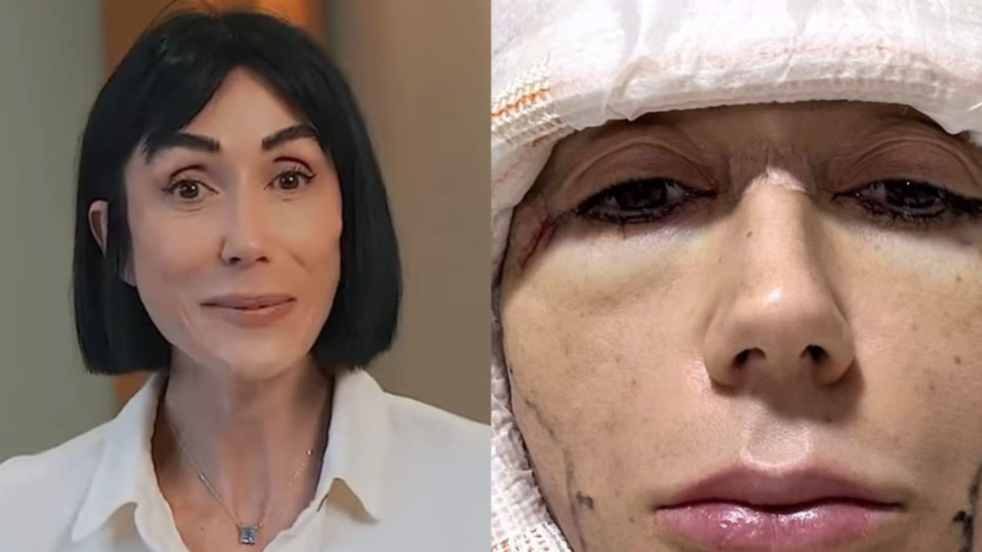 Michelle Barros choca ao mostrar cicatrizes de cirurgia no rosto