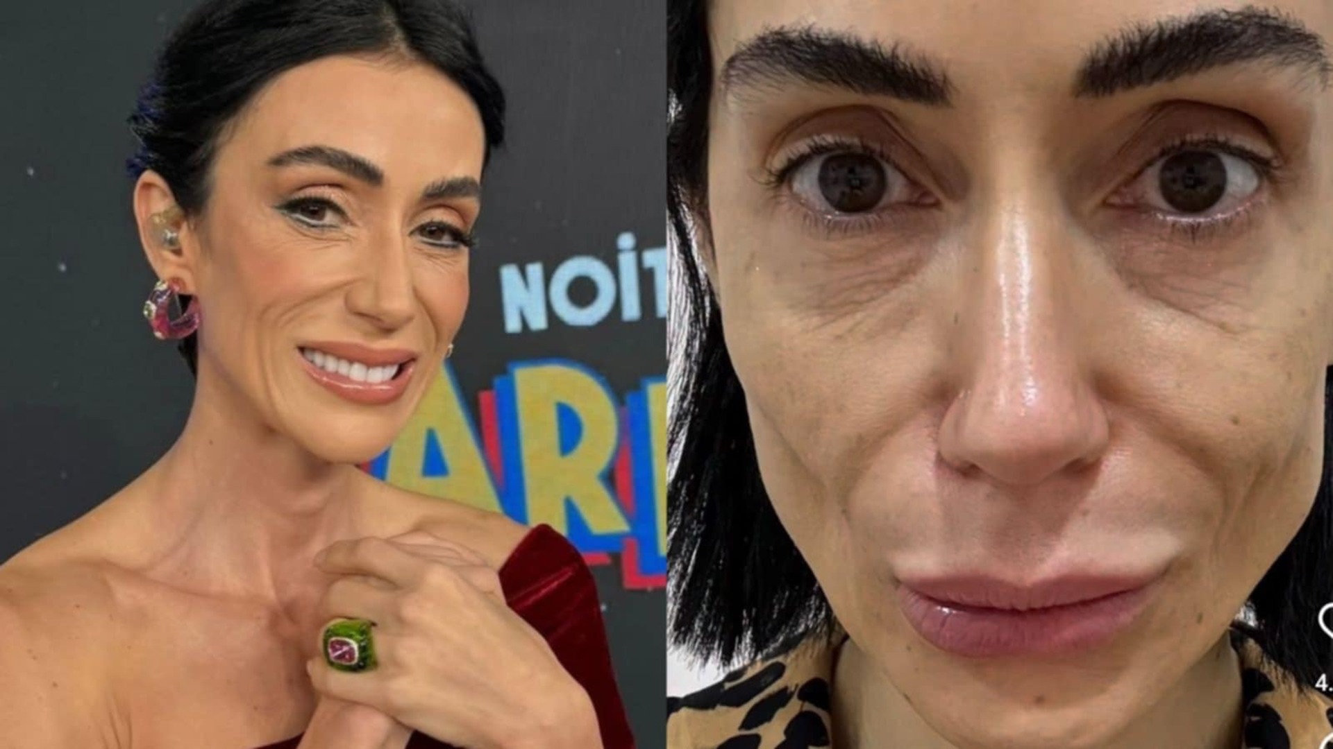 Michelle Barros choca ao mostrar seu rosto após retirada de preenchimentos