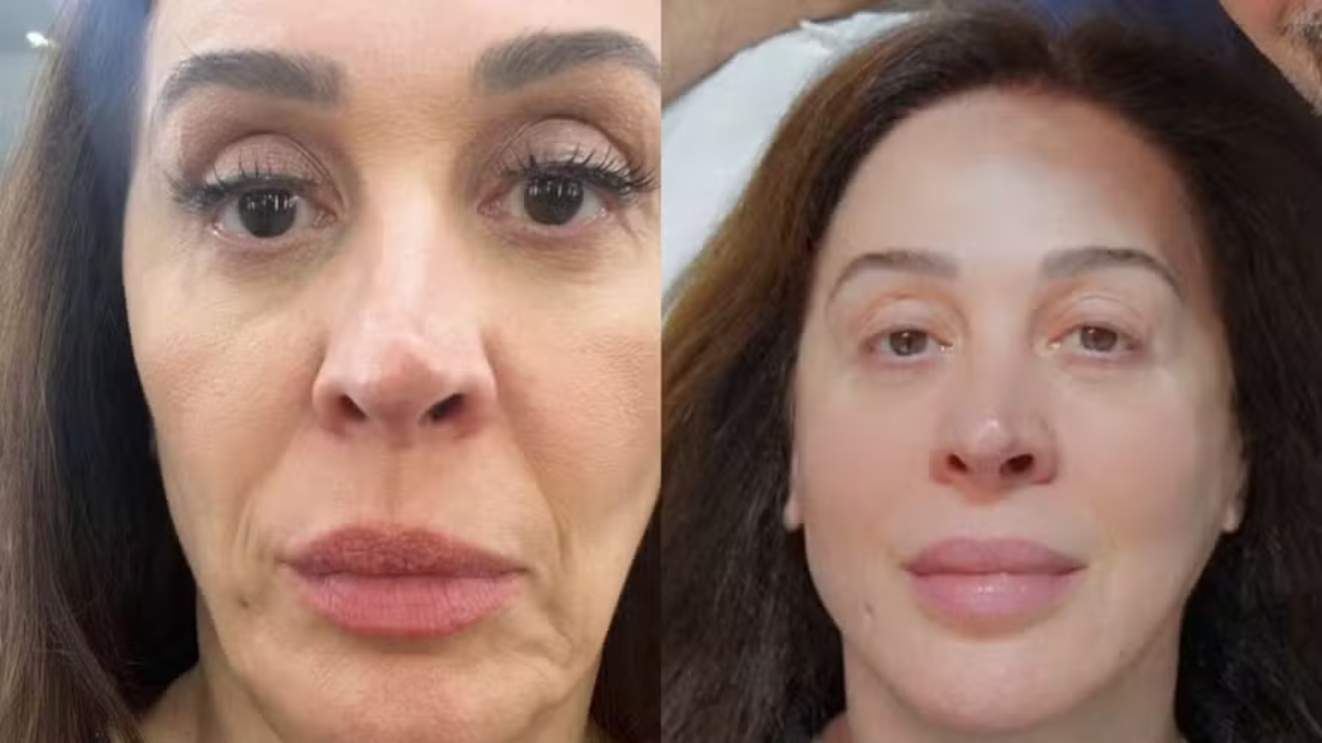 Sem cirurgia! Claudia Raia aposta em procedimento misterioso e especialista alerta: ‘Efeitos’
