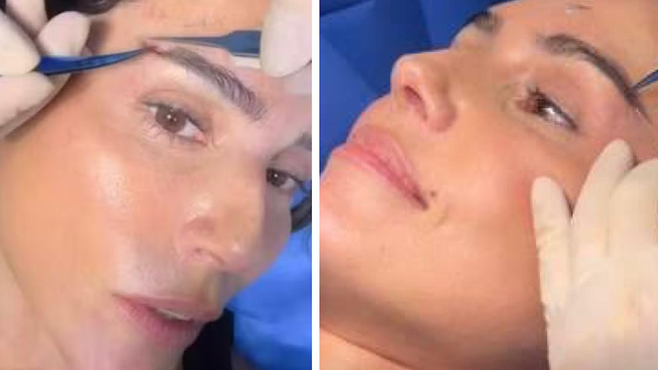 Deborah Secco realiza cirurgia estética e especialista alerta: ‘Não é indicado para…’