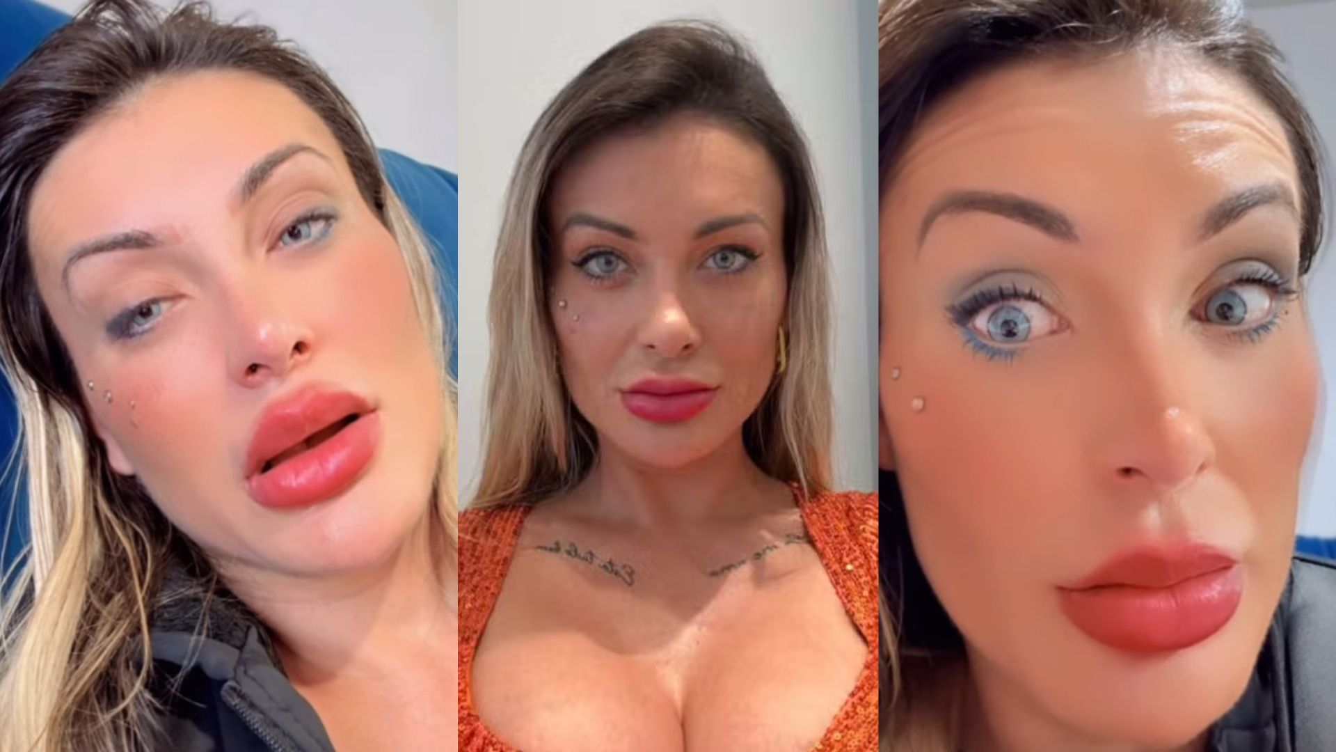 Médico alerta sobre dores após alteração da cor dos olhos de Andressa Urach: ‘Não é considerada normal’