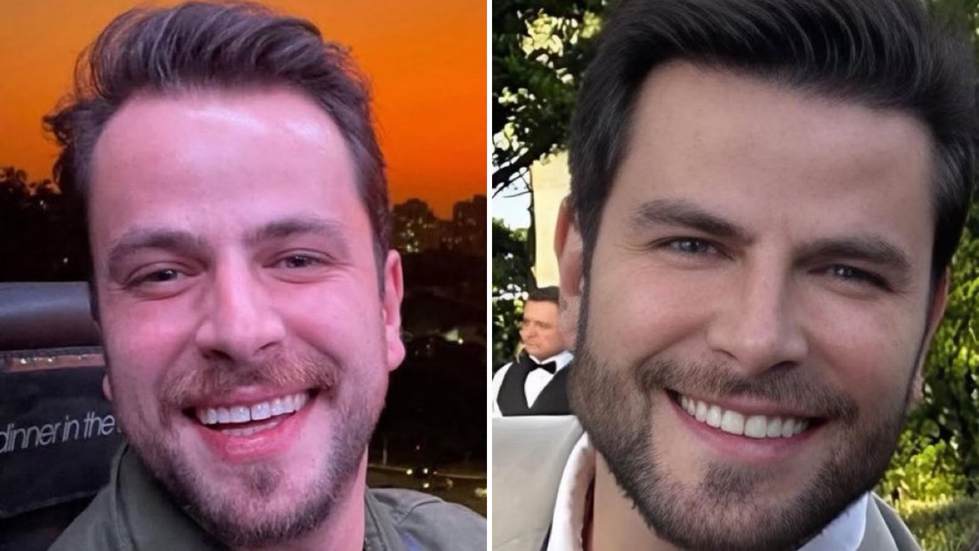 Especialista sobre harmonização do ex-BBB Gustavo Marsengo: ‘Não exige rosto padronizado’