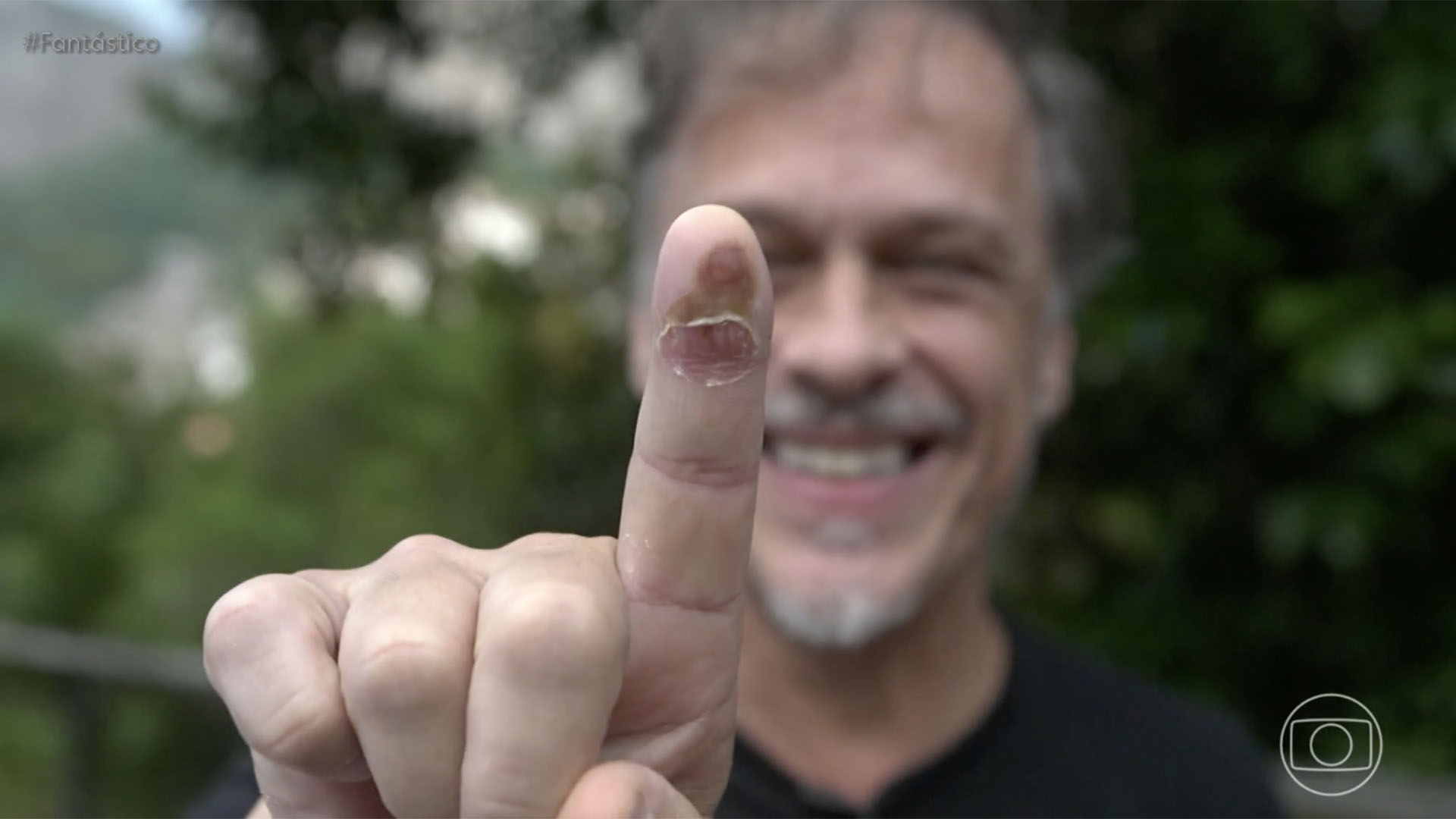 Guilherme Fontes mostra como ficou o dedo ap&oacute;s picada de cobra - Reprodu&ccedil;&atilde;o / TV Globo